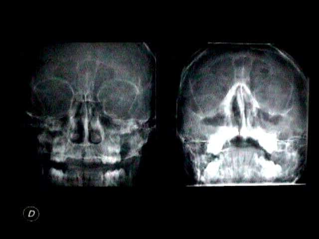 radiografia cranio