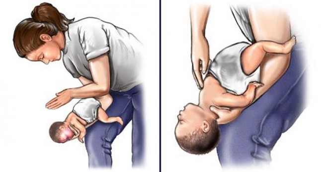 manovra di heimlich neonatale